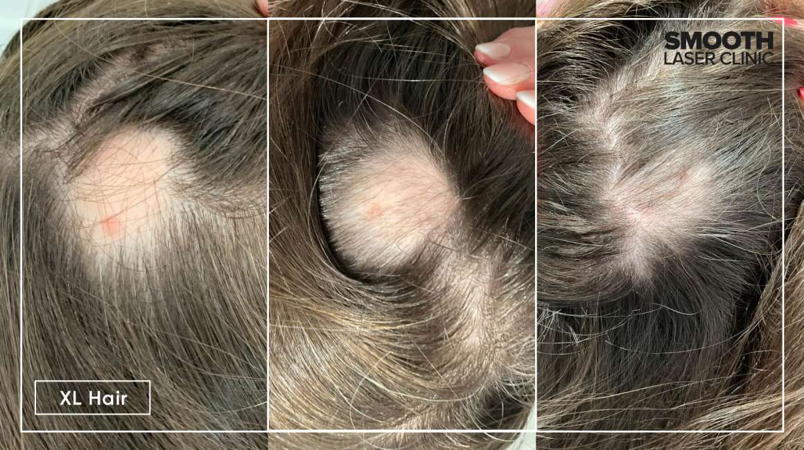 Ervaringen XL Hair alopecia
