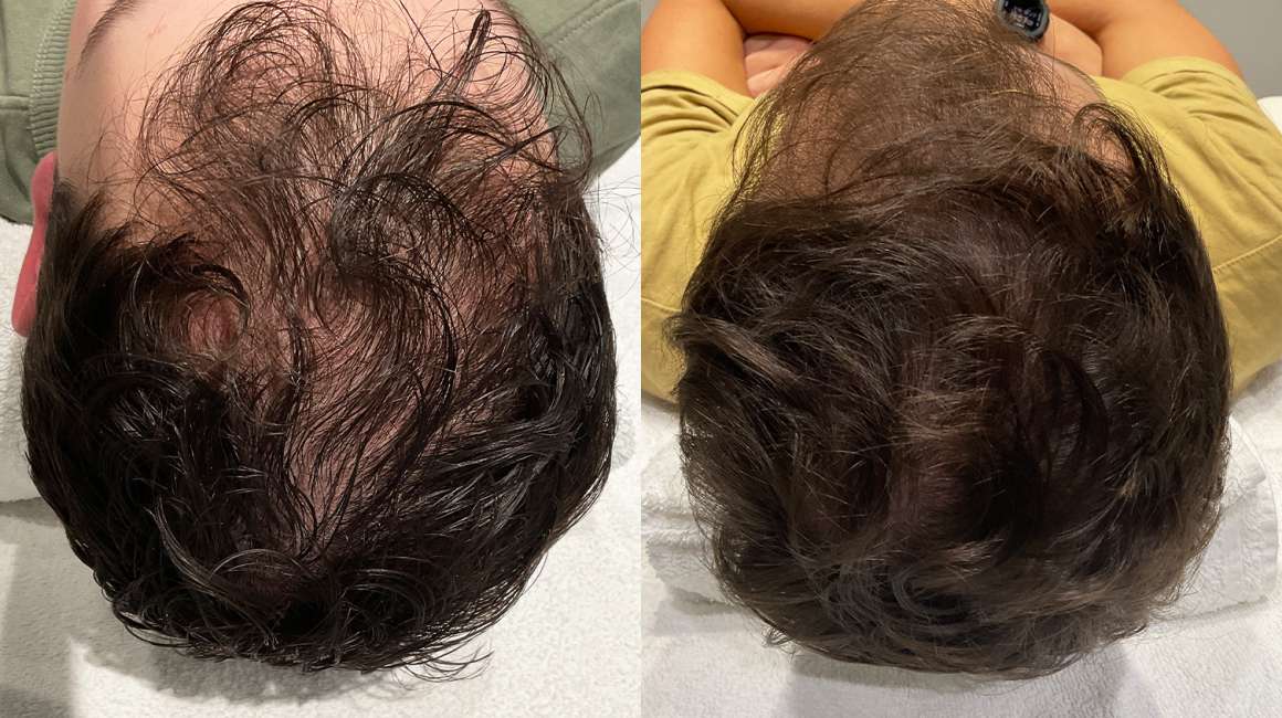 Ervaring-XL-Hair-heren-3