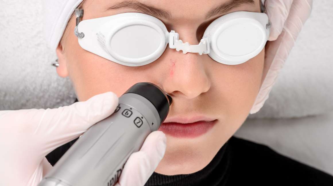 Spider naevus laser behandeling