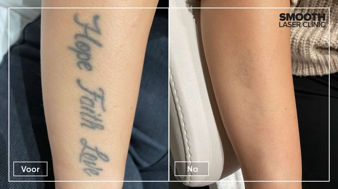 Ervaring Tattoo verwijderen arm